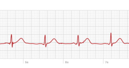 A look at the Apple Watch’s ECG, from someone who needs it