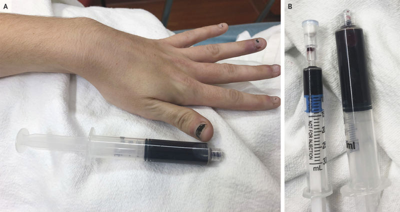 Collage of two photos: one of a discolored hand and the other of a set of hypodermic needles.