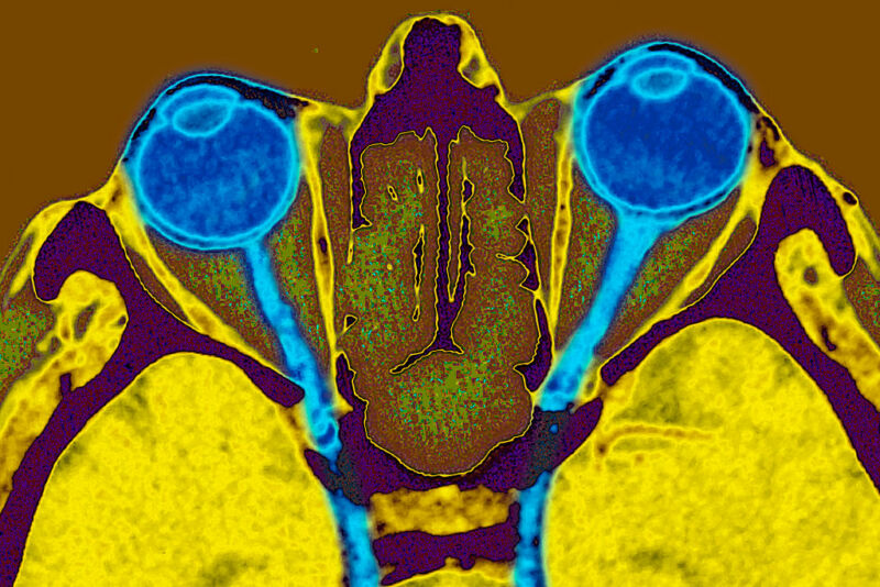 False-color image of a medical image of the interior of a human head.